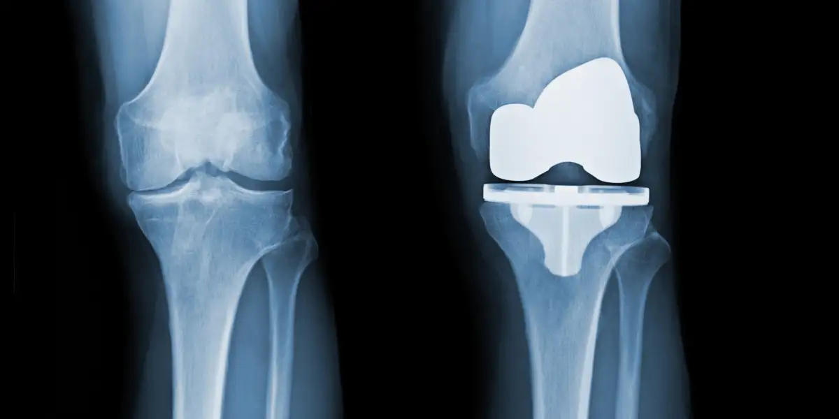 Joint Replacement Devices