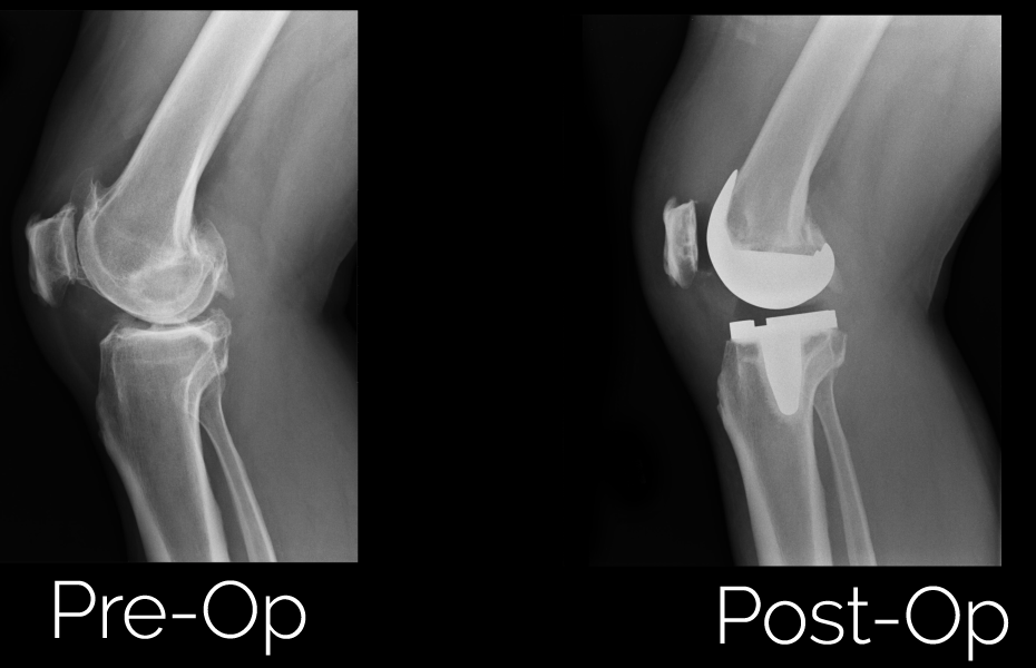Revolutionizing Mobility: A Comprehensive Guide to Joint Replacement Devices